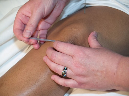 A person is using acupuncture needles to treat an injured leg.